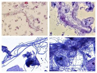 Leptothrix - PAP smear