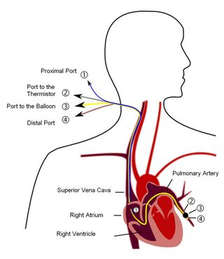 Pulmonary artery catheter