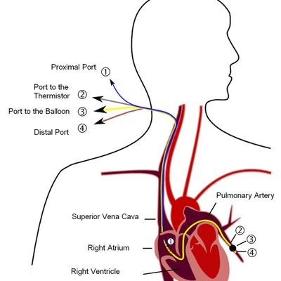 Pulmonary artery catheter