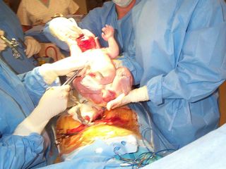 Cesarean section