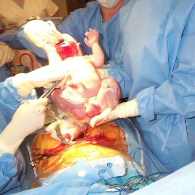 Cesarean section