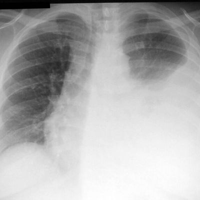 Thoracentesis
